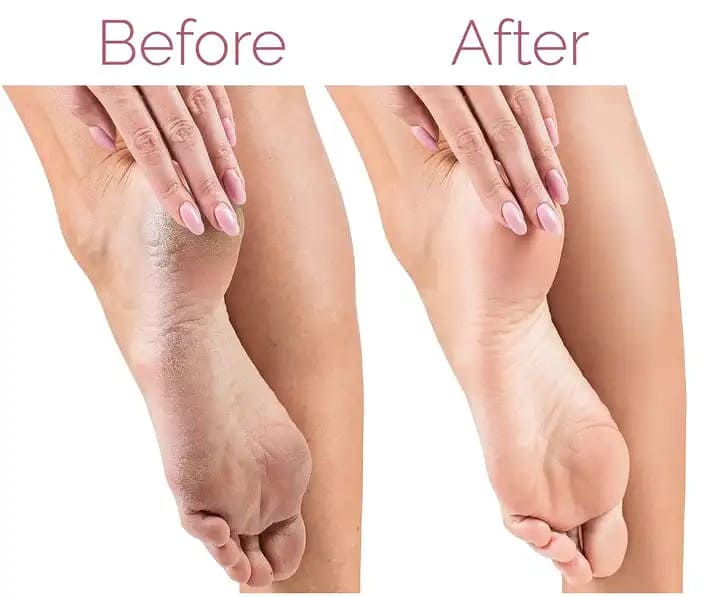 Flawless Pedi Electronic Tool File and Callus Remover